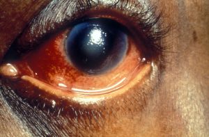Glaucoma: What’s in a word?
